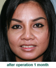 plastic_surgery_augmentation_rhinoplasty